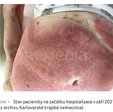 OBR. 1 Stav pacientky na začátku hospitalizace v září 2021 (z archivu Karlovarské krajské nemocnice).