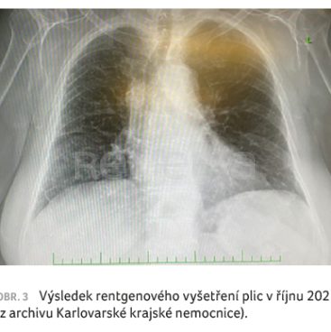 OBR. 3 Výsledek rentgenového vyšetření plic v říjnu 2021 (z archivu Karlovarské krajské nemocnice).