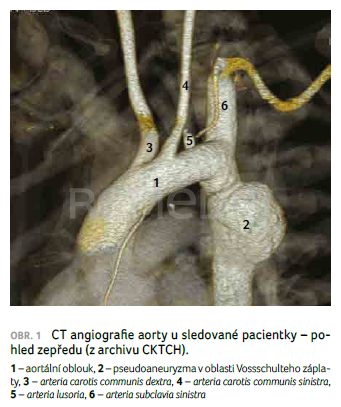 OBR. 1 CT angiografie aorty u&nbsp;sledované pacientky – pohled