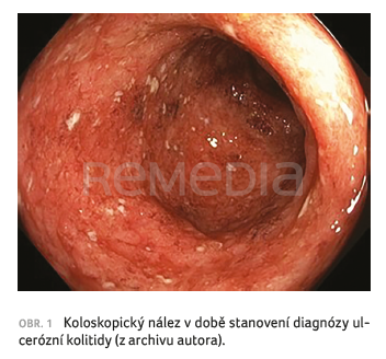 OBR. 1 Koloskopický nález v&nbsp;době stanovení diagnózy