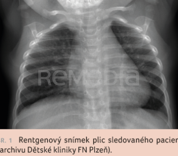 OBR. 1 Rentgenový snímek plic sledovaného pacienta