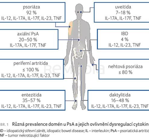 OBR. 1 Různá prevalence domén u PsA a jejich ovlivnění dysregulací cytokinů. IBD – idiopatický střevní zánět, idiopatic bowel disease; IL – interleukin; PsA – psoriatická artritida; TNF – tumor nekrotizující faktor