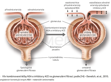 OBR. 1 Vliv kombinované léčby NSA a&nbsp;inhibitory ACE na&nbsp;glomerulární filtraci