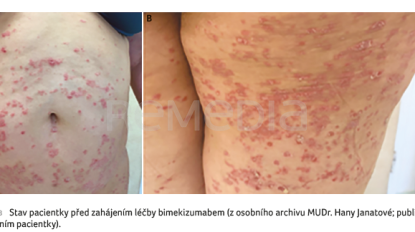 OBR. 1A, B&nbsp;Stav pacientky před&nbsp;zahájením léčby bimekizumabem