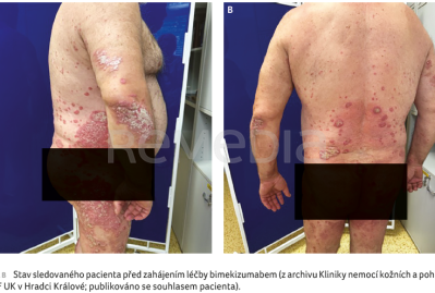 OBR. 1A, B&nbsp;Stav sledovaného pacienta před&nbsp;zahájením léčby bimekizumabem