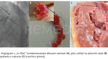 OBR. 1A–C Angiogram s „no flow“ trombotizovaným lékovým stentem