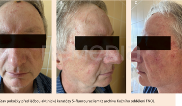 OBR. 1A–C Stav pokožky před léčbou aktinické keratózy 5-fluorouracilem