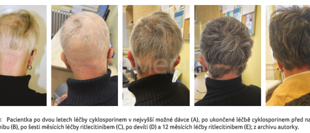OBR. 1A–E&nbsp;Pacientka po&nbsp;dvou letech léčby
