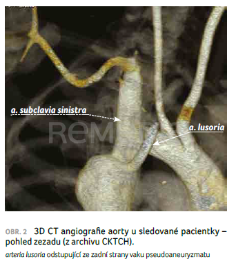 OBR. 2 3D CT angiografie aorty u&nbsp;sledované pacientky – pohled zezadu