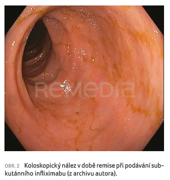 OBR. 2 Koloskopický nález v&nbsp;době remise