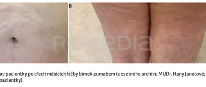 OBR. 2A, B&nbsp;Stav pacientky po&nbsp;třech měsících léčby bimekizumabem