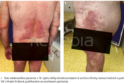 OBR. 2A, B&nbsp;Stav sledovaného pacienta v&nbsp;16. týdnu léčby bimekizumabem