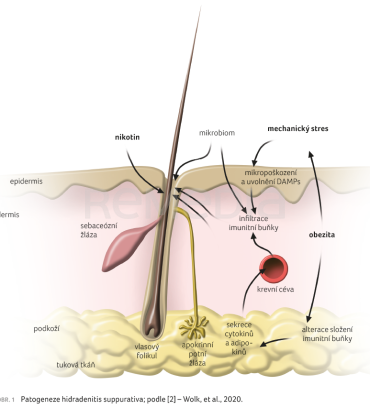 Patogeneze hidradenitis suppurativa