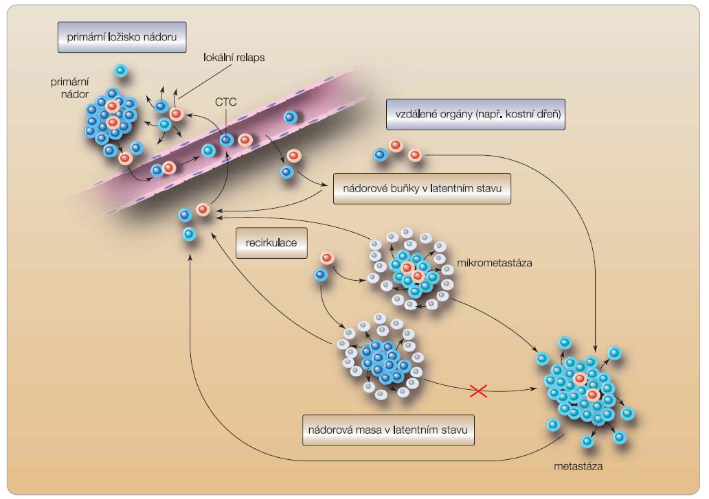  Obr. 1 Model vztahu cirkulujících nádorových buněk (CTC), buněk nádoru a metastáz. 