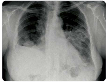 Obr. 1  Zadopřední skiagram hrudníku první pacientky s metastatickým postižením obou plic, vpravo navíc stav po dolní lobektomii. 