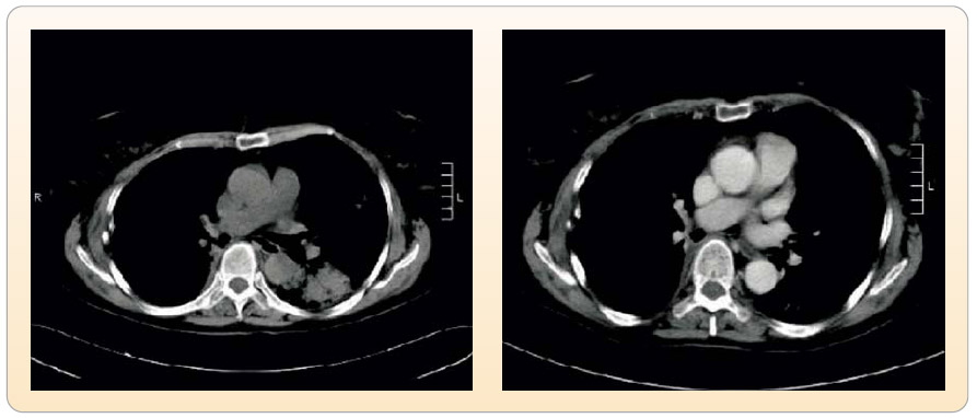 Obr. 3  CT scany u první pacientky, vlevo s tumorózní infiltrací, vpravo regrese tohoto ložiska po zahájení biologické léčby (kontrola CT po 3 měsících). 