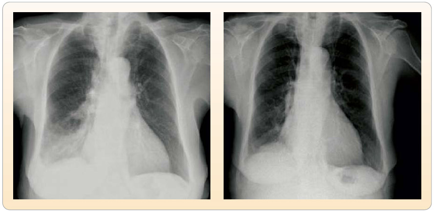 Obr. 6  Zadopřední skiagramy hrudníku třetí pacientky před zahájením terapie erlotinibem a po měsíci léčby. Nádorové postižení pravé plíce dolního laloku. 