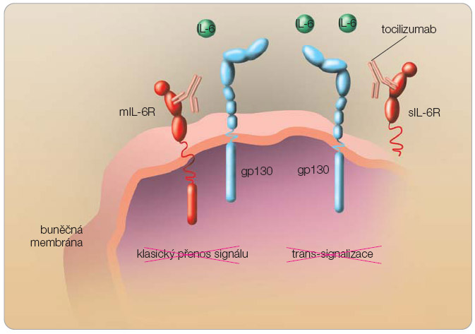 Obr. 2  Humanizovaná monoklonální protilátka tocilizumab brání vazbou na mIL-6R a sIL-6R vzniku aktivačního komplexu receptoru s molekulou gp130, a tím blokuje přenos signálu IL-6; 