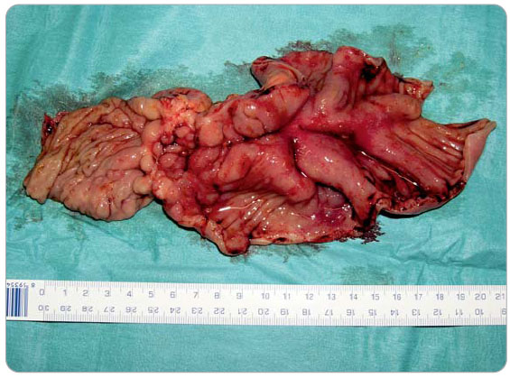  Obr. 1 Resekát ileo-cekální oblasti postižené fibrostenózující formou Crohnovy nemoci. Nápadné je zhrubění sliznice a ztluštění celé stěny tenkého střeva, které způsobuje významné zmenšení střevního průsvitu. 