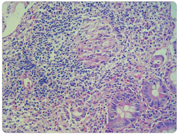  Obr. 2 Histologický obraz nekaseifikujícího granulomu je pro Crohnovu chorobu charakteristickým nálezem. V endobioptickém materiálu je však prokazatelný jen ve 40 % případů. 