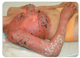 Obr. 1–3 Kožní metastázy karcinomu prsu. 