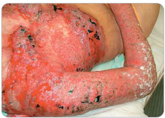 Obr. 1–3 Kožní metastázy karcinomu prsu. 