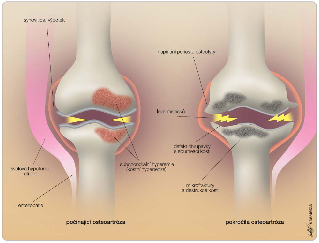 Obr. 1 Příčiny bolesti u osteoartrózy. 