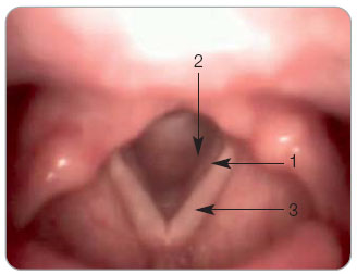 Obr. 1 Pseudosulcus vocalis. Jedná se o zářez (1), který se vytváří mezi subglotickým otokem vznikajícím po podráždění sliznice refluxátem (2) a vlastní hlasivkou (3). Celkový obraz připomíná „částečně otevřený rohlík hot-dog