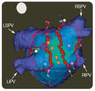 Obr. 2 CARTO 3 elektroanatomické mapování. Carto-merge – superpozice CT obrazu (fialová mapa) a virtuální elektroanatomické mapy LS (zelená mapa); LS – levá síň; LSPV – levá horní plicní žíla; LIPV – levá dolní plicní žíla; RSPV – pravá horní plicní žíla; RIPV – pravá dolní plicní žíla; červené body – ablační léze; žluté body – poloha jícnu při tvorbě mapy; kotvy – konkrétní lokalizace okraje žil dle intrakardiální echokardiografie. Obrázek je publikován se souhlasem autora.