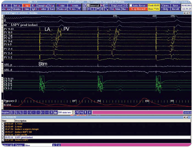 Obr. 3 Intrakardiální EKG, úvod ablace. Stim – stimulační signál, stimulace do proximální části koronárního sinu (zelené signály); žluté signály – signály z Lasso katétru (v ústí levé horní plicní žíly); LA – signál levé síně; PV – signál plicní žíly. Obrázek je výstupem z přístroje a je publikován se souhlasem autora.