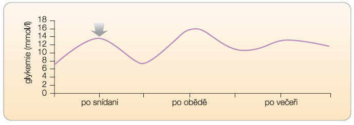 Graf 2 „Specifická“ intervence postprandiální glykemie směřuje k ovlivnění zejména její exkurze ve vztahu ke glykemii nalačno. Znázorněno jako schematický glykemický profil.