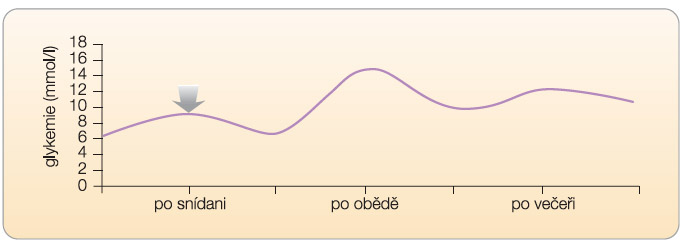 Graf 3 Pokud je „specifická“ intervence správně zvolena, pak vzestup glykemie postprandiálně se zmenší a zmenší se také její absolutní výška. Znázorněno jako schematický glykemický profil. Ve skutečnosti ovlivnění postprandiální glykemie po snídani ovlivní i průměrnou výšku glykemie během zbytku dne.