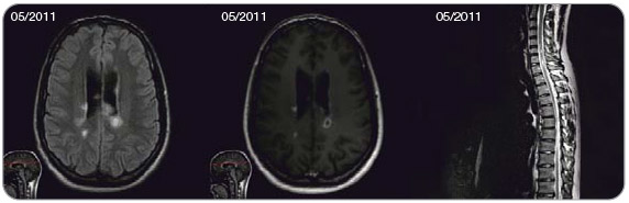 Obr. 4  Mnohočetné ložiskové postižení mozku i míchy na MR včetně gadolinium enhancementu u nově diagnostikovaného pacienta.