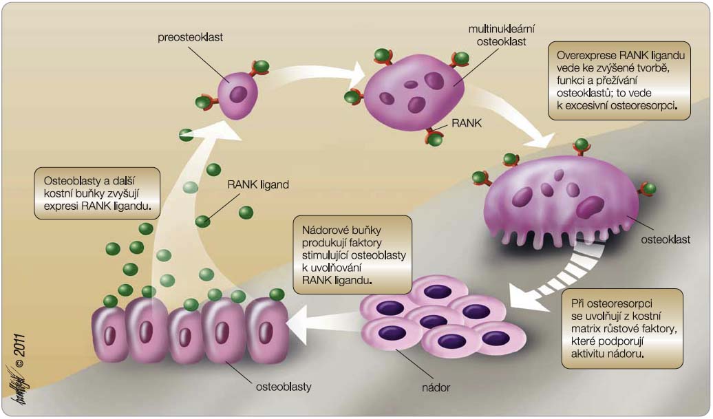 Obr. 1  Interakce mezi nádorovými buňkami a kostní tkání; volně podle [8] – Roodman, 2004; RANK – receptor activator of nuclear factor kB