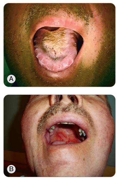 Obr. 2 Akutní slizniční změny v dutině ústní po ozáření: A) prosáknutí sliznice, tzv. scalloping; B) erytém a defekt krytý pseudomembránou v oblasti patra.