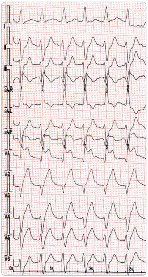Obr. 1 Vstupní EKG s elevacemi ST úseků v hrudních svodech