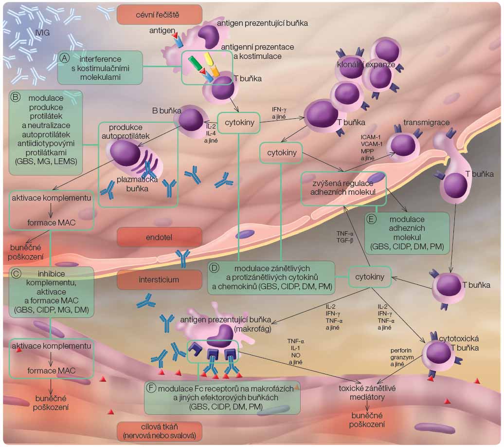 Obr. 1 Imunomodulační mechanismy IVIG u autoimunitních nervosvalových chorob; volně podle [25–27] – Dalakas, 1999; Bayry, et al., 2003; Quick, et al., 2011. Intravenózní imunoglobulin (IVIG) moduluje řadu imunologických pochodů (A–F), které se podílejí na imunopatogenezi autoimunitních nervosvalových onemocnění (blíže v textu). Jsou uvedeny specifické léčebné účinky na základě experimentálních důkazů. Jinými předpokládanými mechanismy IVIG, které nejsou uvedeny, jsou např. narůstající katabolismus IgG, alterace efektorových funkcí T buněk a modulace apoptózy. CIDP – chronická zánětlivá demyelinizační polyneuropatie; DM – dermatomyozitida; GBS – Guillainův-Barréův syndrom; ICAM-1 – intercelulární adhezní molekula 1; IFN-γ – interferon γ; IL – interleukin; LEMS – Lambertův-Eatonův myastenický syndrom; MAC – membrány atakující komplex; MG – myasthenia gravis; MPP – matrixová metaloproteináza; NO – oxid dusnatý; PM – polymyozitida; TGF-β – transformující růstový faktor β; TNF-α – tumor nekrotizující faktor α; VCAM-1 – vaskulární adhezní molekula 1