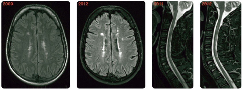 Obr. 3 Mnohočetná ložiska převážně periventrikulárně, rozsáhlé demyelinizace intramedulárně. Při sledování v čase MR obraz bez podstatných změn.