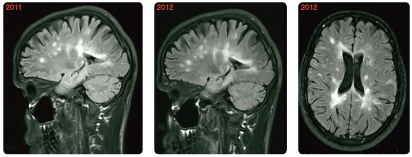 Obr. 4 Mnohočetná ložiska demyelinizace supratentoriálně periventrikulárně a paraventrikulárně, atrofie mozku. Dlouhodobě bez známek aktivity, bez vývoje v MR obraze.