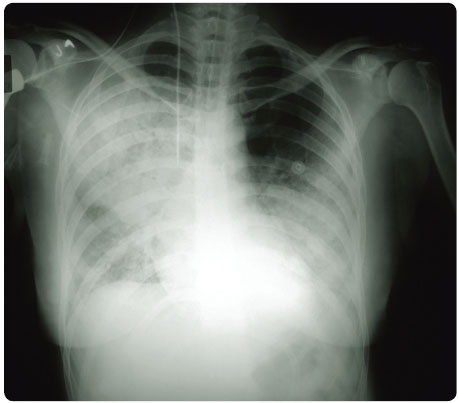 Obr. 1 Nehomogenní drobně skvrnité infiltrativní zastření v obou plicních křídlech.