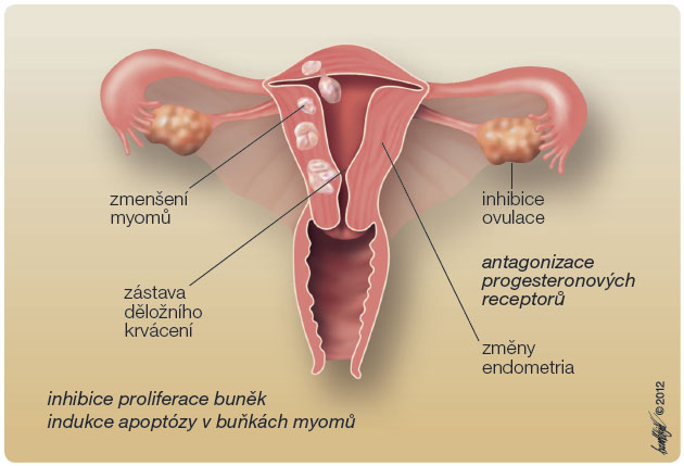  Obr. 2 Mechanismus účinku ulipristal acetátu na dělohu. Ulipristal acetát účinkuje parciálně agonisticky/antagonisticky skrze progesteronové receptory. Jeho působením dochází k inhibici ovulace, změnám endometria a v důsledku inhibice proliferace a indukce apoptózy buněk myomů dochází ke zmenšení velikosti myomů a k zástavě děložního krvácení.