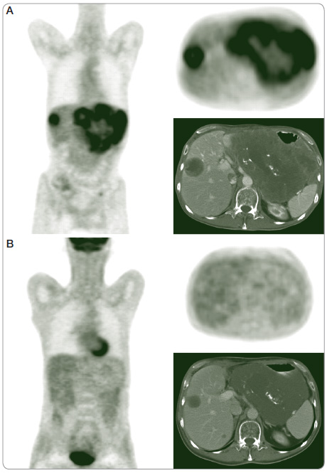 Obr. 1 Nález dokumentuje PET/CT aktivitu před opětovným zahájením léčby  imatinibem (A) v prosinci 2009 a za 8 týdnů (B) od počátku léčby (v únoru 2010),  kdy došlo k výrazné regresi PET aktivity pokročilého nádoru. PET/CT – diagnostická metoda spojující vyšetření počítačovou tomografií (CT) a pozitronovou emisní tomografií (PET)