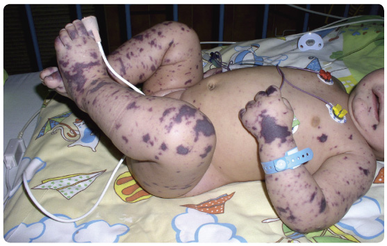 Obr. 1 Rozsáhlé sufuze u dítěte se smíšenou formou meningokokového onemocnění (sepse s meningitidou).
