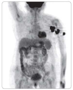 Obr. 1 PET vyšetření před zahájením léčby ipilimumabem – metastázy v levé axile a paži.