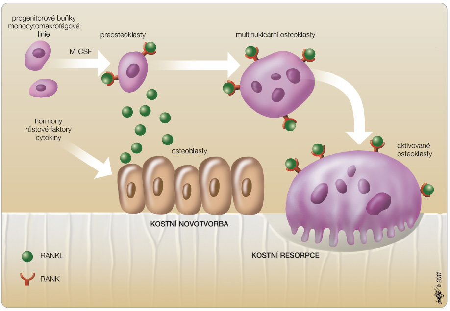 Obr. 3 Úloha RANKL v kostní remodelaci; převzato z Remedia 3/2011. Osteoblasty v kostní tkáni produkují cytokin RANKL. Jeho vazba na receptor (RANK) je klíčová pro další děje osteogeneze. M-CSF – růstový faktor (macrophage colony-stimulating factor); RANK – receptor aktivující nukleární faktor κB; RANKL – ligand RANK