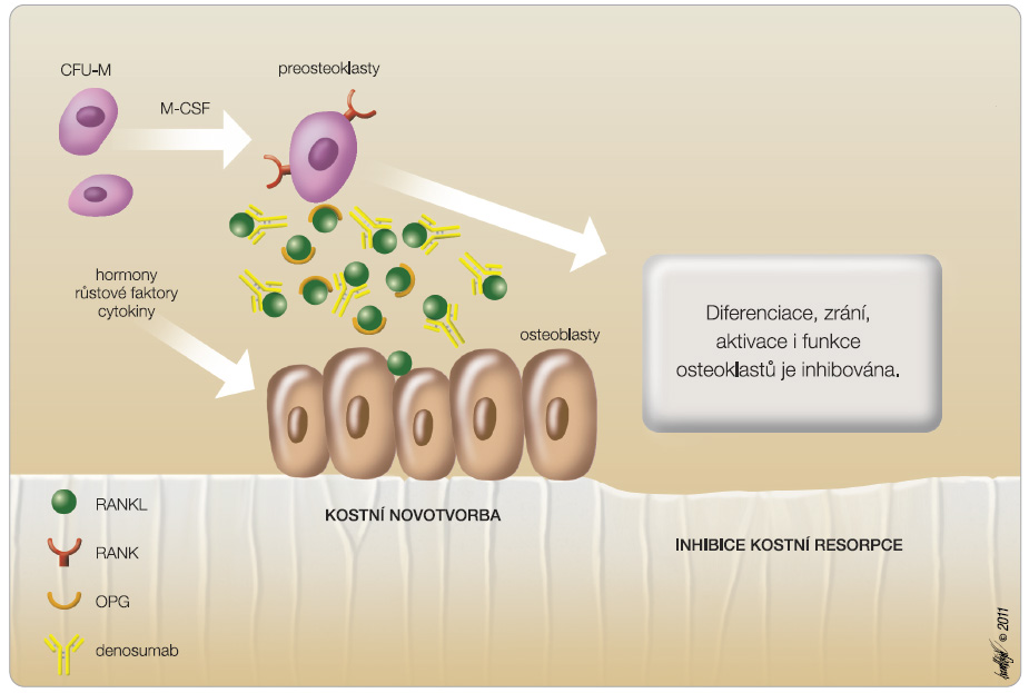 Obr. 4 Mechanismus účinku denosumabu; převzato z Remedia 3/2011. Denosumab, monoklonální protilátka proti RANKL, se kompetitivně váže na RANKL, čímž znemožňuje interakci RANK-RANKL, klíčovou v procesu  osteoklastogeneze. Přirozeně takto působí osteoprotegerin produkovaný osteoblasty. CFU-M – prekurzorová buňka (colony-forming-unit-macrophage); M-SF – růstový faktor (macrophage colony-stimulating factor); OPG – osteoprotegerin; RANK – receptor aktivující nukleární faktor κB; RANKL – ligand RANK