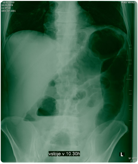 Obr. 2 Nativní snímek břicha ze dne 18. 3. 2009.