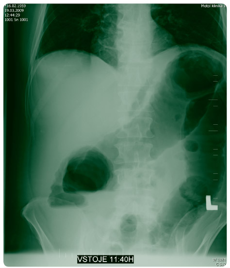  Obr. 3 Nativní snímek břicha ze dne 19. 3. 2009.