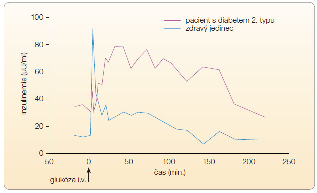 Graf 1 Sekrece inzulinu v průběhu intravenózního glukózového tolerančního testu s frekventním odběrem; podle autora (původní data). Je zřejmé, že u osoby zdravé je inzulinemie nalačno nižší (dobrá senzitivita tkání k inzulinu), je zachována první fáze sekrece inzulinu, která naopak u osoby s diabetem 2. typu chybí, a je zřetelně nižší sekrece v druhé fázi odpovědi na intravenózně aplikovanou glukózu (0,33 g/kg).
