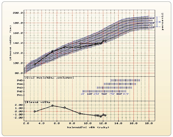 Graf 2 Bifázická porucha růstu u chlapce s kraniofaryngeomem; podle [10] – Krásničanová, et al., 2000. Po období, kdy chlapec výrazně převyšoval rodinnou růstovou predikci (modré označení „x“ vpravo v grafu), došlo k růstovému selhání. Mezi 7. a 12. rokem vyrostl pouze o 7 cm, tedy růstová rychlost dosahovala 1,4 cm/rok oproti očekávaným 6–8 cm/rok. Růstové selhání je urgentním stavem v pediatrii.